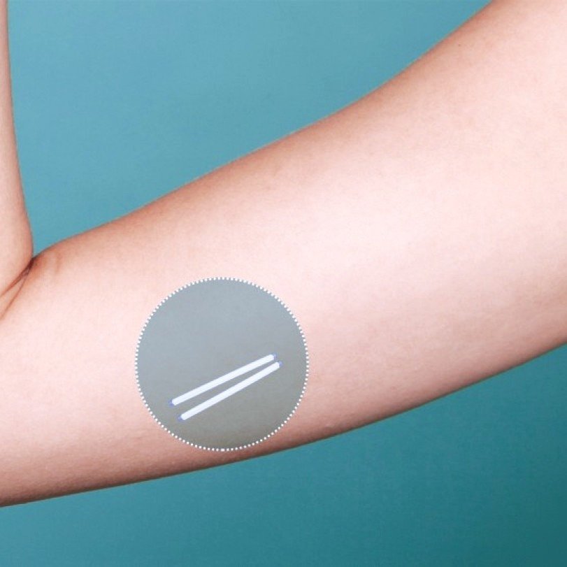 Inserción y retiro de dispositivo subdermico (Jadelle)